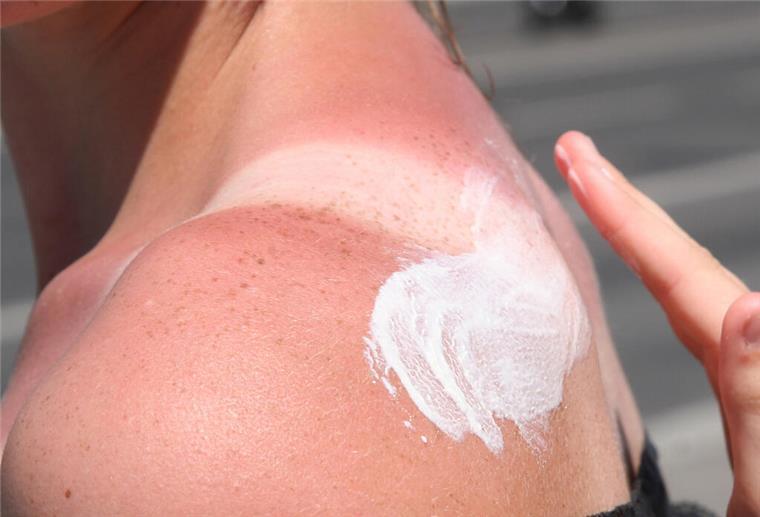 Schmerz, Rötung, Jucken: Was du bei Sonnenbrand wirklich tun solltest Eine Frau trägt Creme auf einen Sonnenbrand auf. Am Strand weggedöst oder stundenlang im Garten gearbeitet - ohne genug Sonnenschutz und Schattenpausen? Das kann mit einem fiesen Sonnenbrand enden. Eine Dermatologin verrät, was der Haut dann guttut.