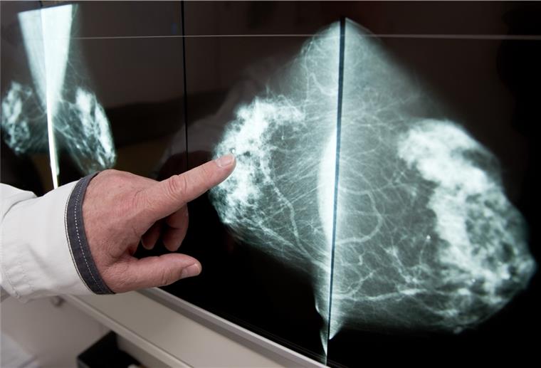 Beim Mammographie-Screening werden schon frühzeitig Veränderungen in der Brust, wie hier eine gutartige Fettzellen-Verkalkung, erkannt.