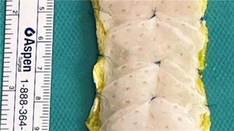 Stammzell-Herzpflaster soll schwere Herzschwäche kurieren Das „Herzpflaster“ wird aus Einzelteilen zusammengesetzt.