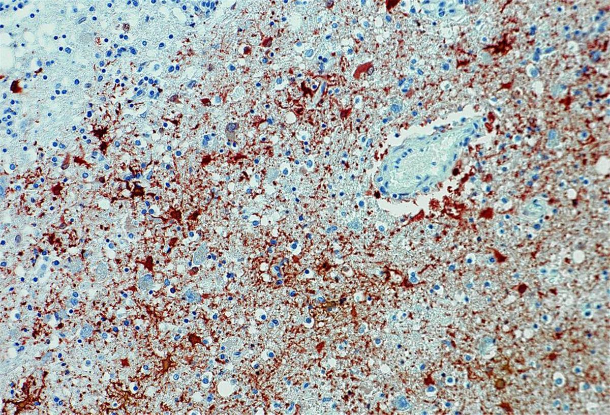 Die undatierte Aufnahme zeigt einen Anitkörpernachweis zum Borna-Virus im Gewebe. Da Virus ist in Deutschland auf dem Vormarsch. 