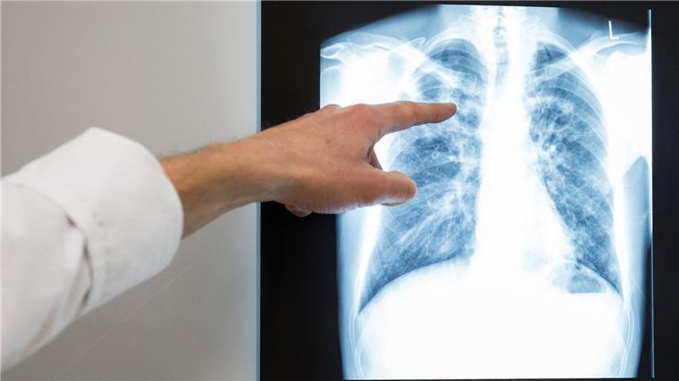 Ein Arzt zeigt im Vivantes Klinikum Neukölln auf das Röntgenbild einer Lunge.