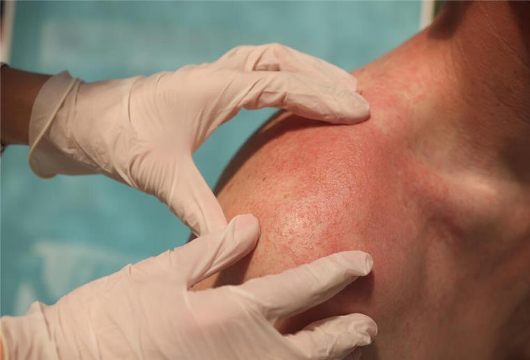 Wenn Sonne unangenehmen Juckreiz verursacht Ein Arzt mit Handschuhen tastet eine Sonnenallergie an einer Schulter ab