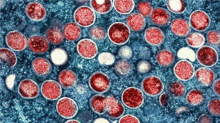 Neue Mpox-Variante im Land – was der erste Fall bedeutet Es gibt Impfstoffe, die den Mpox-Krankheitsverlauf mildern können. (Archivbild)
