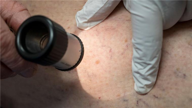 Krankenkasse: Deutlich mehr Hautkrebsfälle in Niedersachsen Hautkrebsfälle steigen nach Krankenkassen-Zahlen in Niedersachsen deutlich an. (Symbolbild)