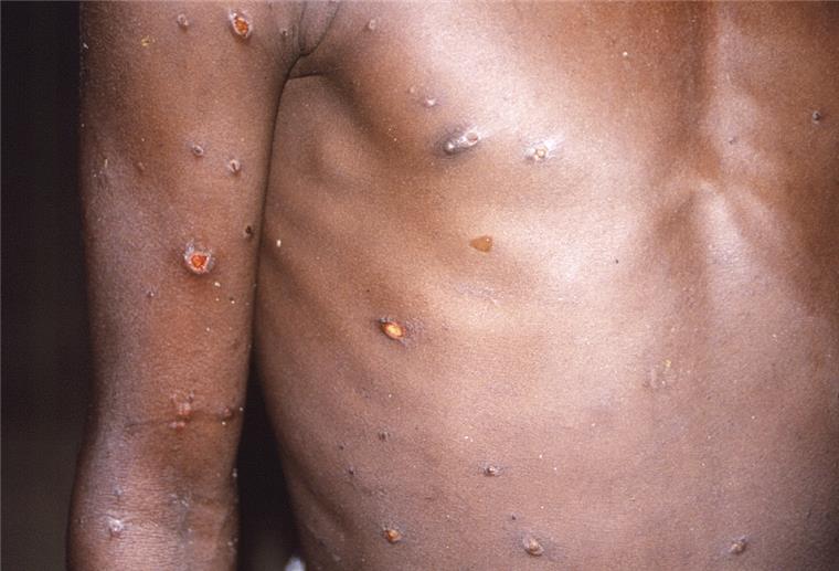 Dieses vom CDC zur Verfügung gestellte Bild aus dem Jahr 1997 zeigt den rechten Arm und den Oberkörper eines Patienten, dessen Haut eine Reihe von Läsionen aufwies, die auf einen aktiven Fall von Affenpocken zurückzuführen waren.