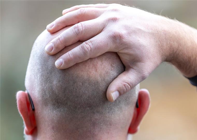 Jeder zweite Mann mit 50 Jahren ist von Haarausfall betroffen. 
