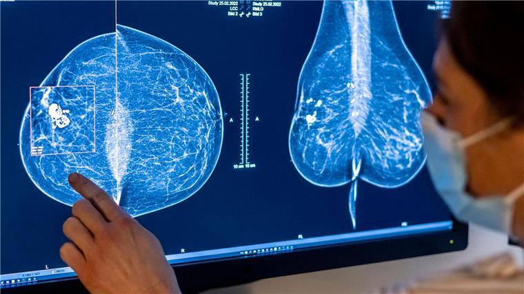 Mit einer Mammografie wird die Brust einer Frau auf Brustkrebs untersucht.