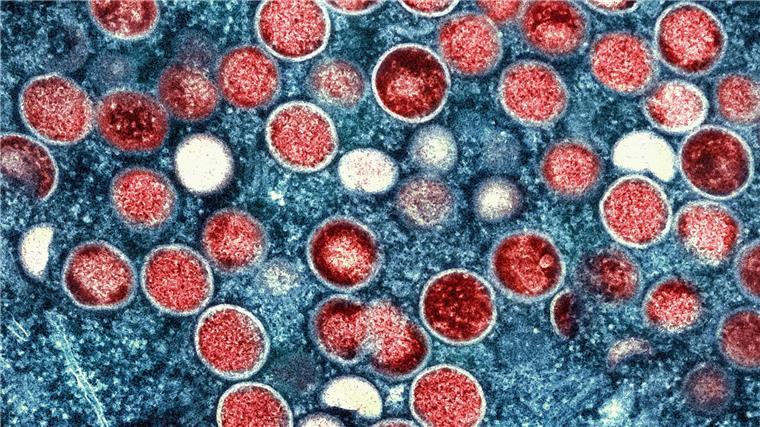 Mpox Klade IIb wird durch engen Körperkontakt übertragen, vor allem beim Sex. (Archivbild)