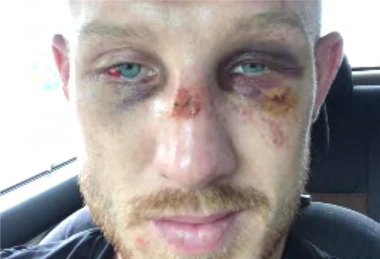 Thaiboxen: Weltmeister Schroth verliert in Pattaya Pascal Schroth ist nach seinem Kampf schwer gezeichnet - aber er greift wieder an.