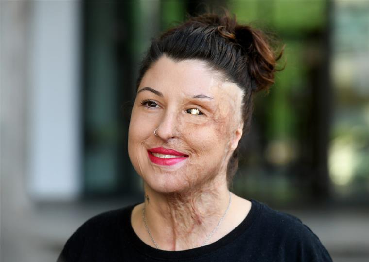 Vanessa Münstermann, Opfer eines Säure-Anschlags,  hat geheiratet. 